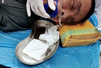 CỨU NGƯỜI ĐÀN ÔNG NHIỀU LẦN NUỐT KIM LOẠI DO RỐI LOẠN TÂM THẦN