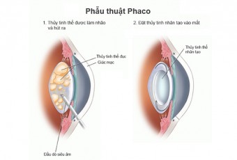 Trung tâm Y tế Việt Yên triển khai chương trình khám sàng lọc tất cả các bệnh về mắt và thu dung phẫu thuật đục thuỷ tinh thể bằng phương pháp Phaco